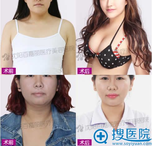 沈阳百嘉丽整形胸部及下巴整形案例 沈阳百嘉丽整形胸部及下巴整形案例