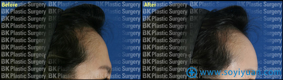 ����BK����ҽԺ��ͷ֬����ֲ����