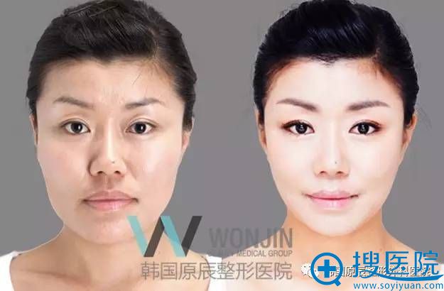 韩国原辰整形外科医院下巴整形真人案例 韩国原辰整形外科医院下巴整形真人案例