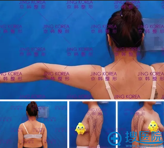 ����Bodytite�ƽ�΢����Ƶ��֬���˰��� һ�ΰ��Ѻ�����