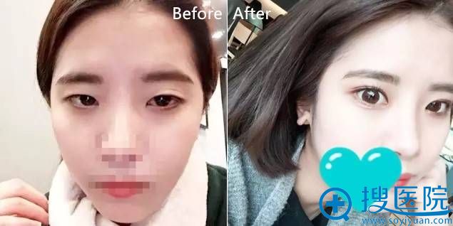 ���ݺ�Ͽ����ҽԺ˫��Ƥ��������ʽ�޺�˫��Ƥ980Ԫ