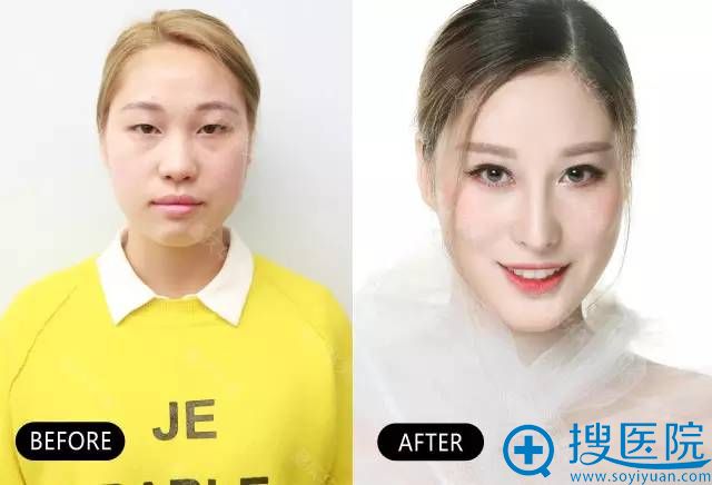 重庆华美整形医院韩式综合隆鼻真人案例 重庆华美整形医院韩式综合隆鼻真人案例
