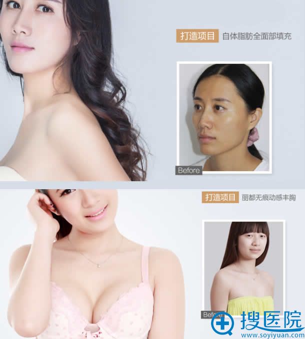 无锡丽都自体脂肪填充及隆胸案例 无锡丽都自体脂肪填充及隆胸案例