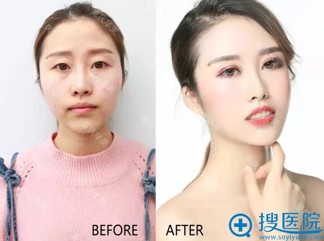 重庆华美整形医院半纹绣真人案例 重庆华美整形医院半纹绣真人案例