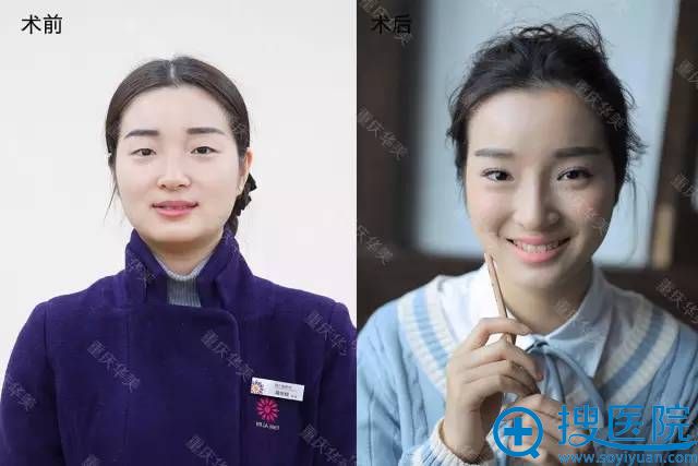 重庆华美整形医院双眼皮整形真人案例 重庆华美整形医院双眼皮整形真人案例