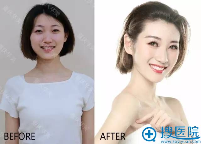 重庆华美整形医院双眼皮+开眼角+隆鼻真人案例 重庆华美整形医院双眼皮+开眼角+隆鼻真人案例