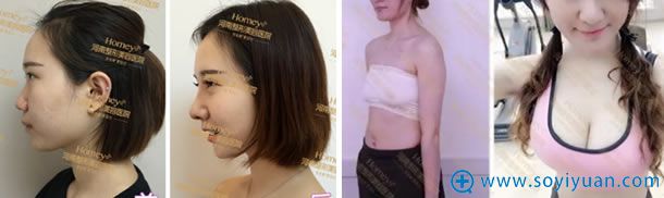 河南整形美容医院隆鼻和丰胸案例 河南整形美容医院隆鼻和丰胸案例