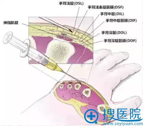 手部脂肪室分布图 手部脂肪室分布图