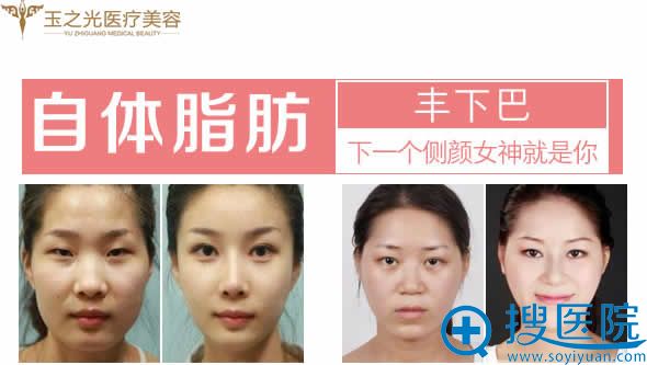 北京玉之光王明利自体脂肪丰下巴案例 北京玉之光王明利自体脂肪丰下巴案例