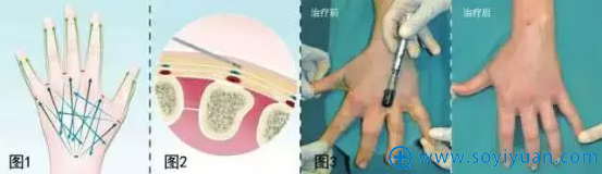 手部脂肪室相对应可以注射的脂肪量 手部脂肪室相对应可以注射的脂肪量