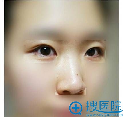 【 温州艺星整形医院揭秘】7天拆线后鼻子能恢复到什么程度?