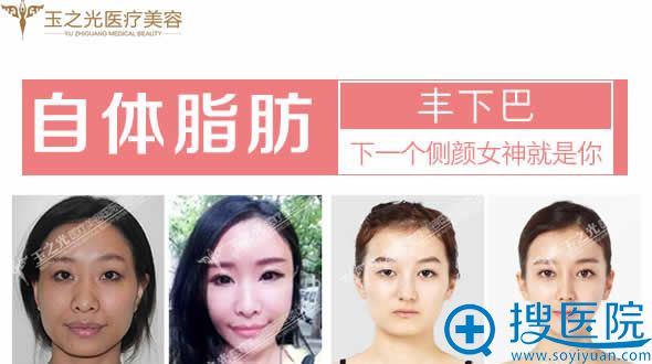 玉之光王明利自体脂肪丰下巴效果图 玉之光王明利自体脂肪丰下巴效果图