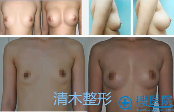北京清木整形假体隆胸案例效果图 北京清木整形假体隆胸案例效果图