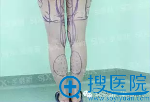 陈丽丽腿部吸脂方案 陈丽丽腿部吸脂方案