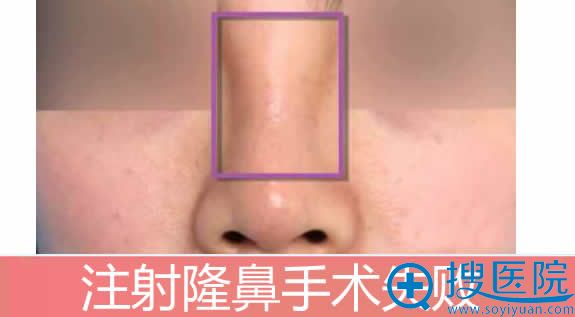 <!--<i data=20240710 data-id=16581></i>-->院长分析注射隆鼻失败怎么办 <!--<i data=20240710 data-id=16581></i>-->院长分析注射隆鼻失败怎么办