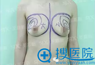 陈丽丽胸部填充方案 陈丽丽胸部填充方案