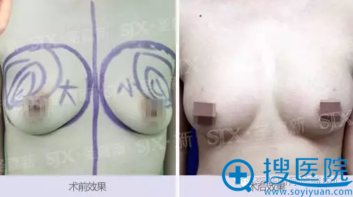 陈丽丽自体脂肪隆胸术前术后效果对比 陈丽丽自体脂肪隆胸术前术后效果对比