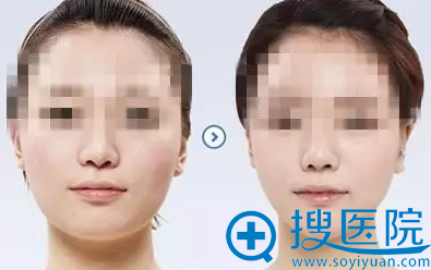 当代微精塑智能面部溶脂案例 当代微精塑智能面部溶脂案例