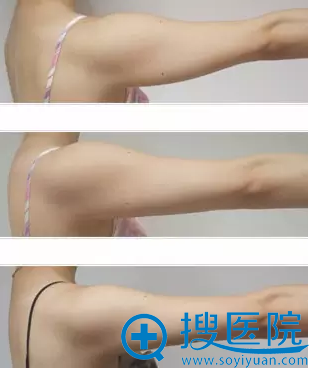 当代微精塑智能手臂溶脂案例 当代微精塑智能手臂溶脂案例
