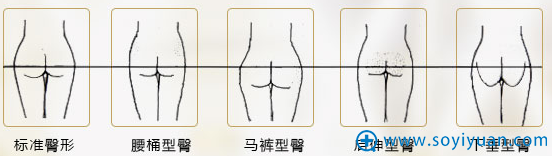 北京京韩整形之OMR自体脂肪复合层次丰臀