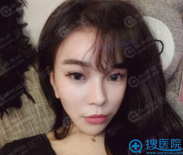 karida术后一个月效果 karida术后一个月效果