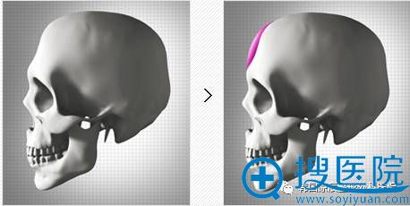 额头填充物植入手术方法示意图 额头填充物植入手术方法示意图