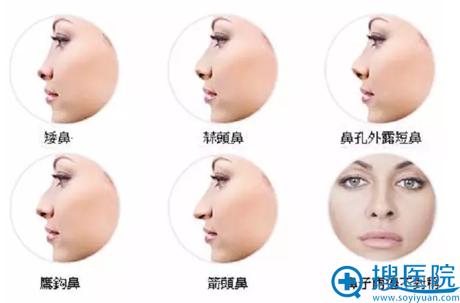 适合假体隆鼻的鼻子类型 适合假体隆鼻的鼻子类型