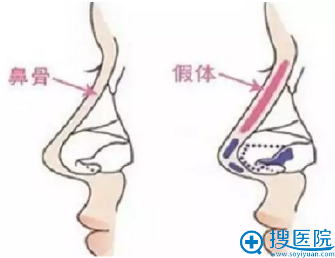 假体隆鼻假体植入位置 假体隆鼻假体植入位置