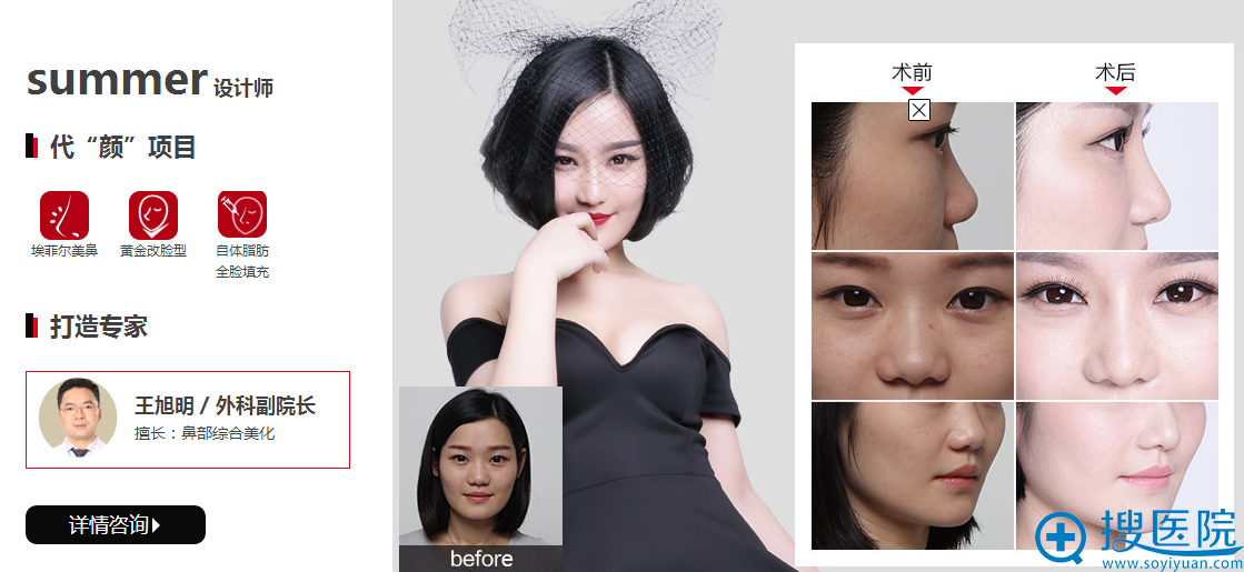 重庆当代整形医院王旭明埃菲尔美鼻案例 重庆当代整形医院王旭明埃菲尔美鼻案例