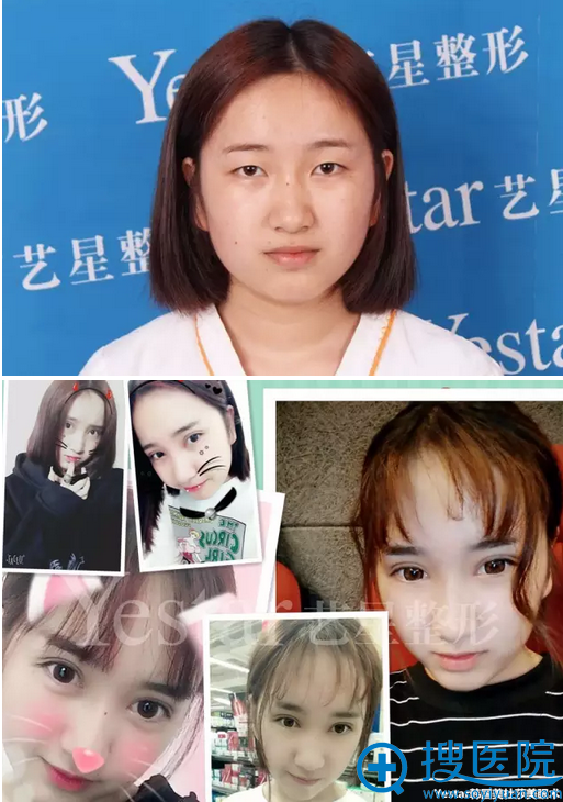 美杜莎综合美眼术前后对比照片 美杜莎综合美眼术前后对比照片