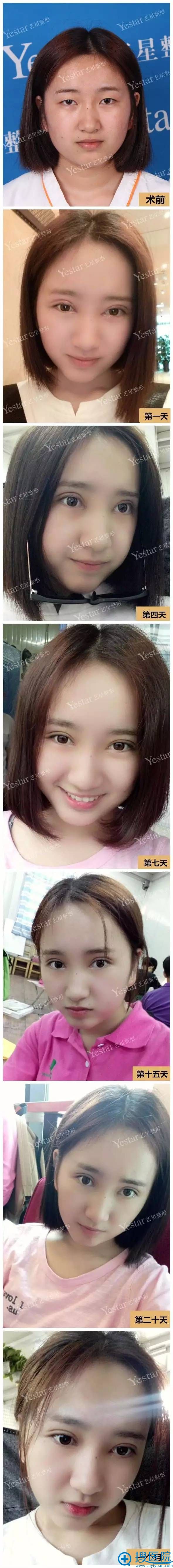 美杜莎综合美眼术天到一个月的恢复照片 美杜莎综合美眼术天到一个月的恢复照片