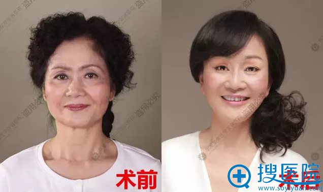 周晓玲术术后对比照片 周晓玲术术后对比照片