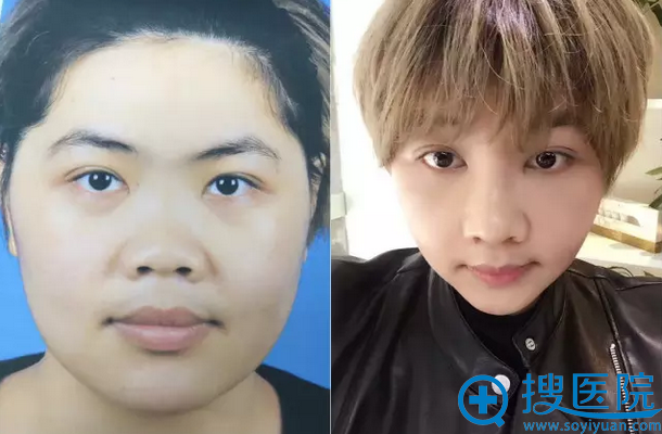 李保锴教授鼻整形案例一 李保锴教授鼻整形案例一