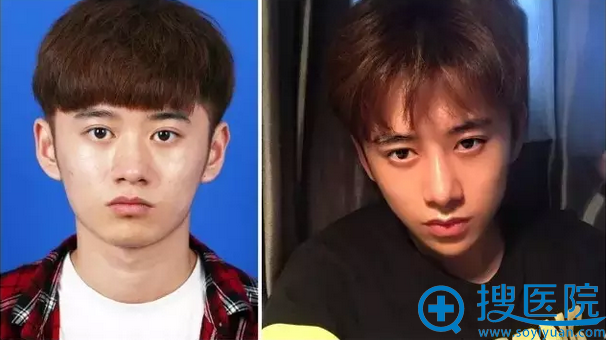 李保锴教授鼻整形案例二 李保锴教授鼻整形案例二