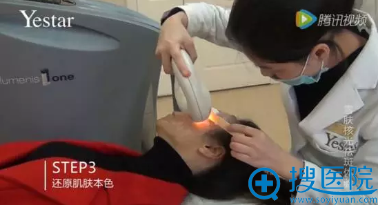 艺星雪肤核光第三步开始表皮层治疗 艺星雪肤核光第三步开始表皮层治疗
