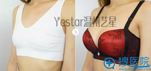 较后放一张隆胸前后对比照片,差距真的很大。现在超幸福 较后放一张隆胸前后对比照片,差距真的很大。现在超幸福