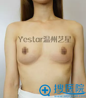这是术前的胸部照片,因为产后哺乳萎缩成A罩杯 这是术前的胸部照片,因为产后哺乳萎缩成A罩杯