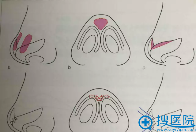 酒井直彦医生鼻尖缩小手术过程图解 酒井直彦医生鼻尖缩小手术过程图解