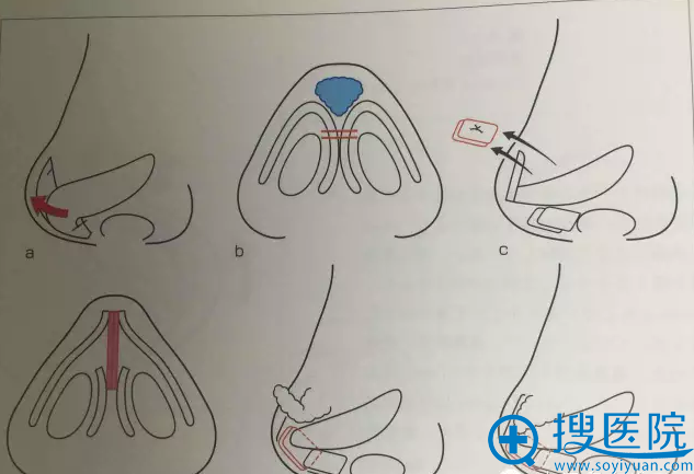 酒井直彦医生鼻尖缩小手术支架法图解 酒井直彦医生鼻尖缩小手术支架法图解