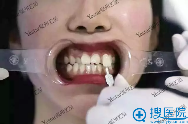 看我在温州艺星整形医院做的美容冠每颗价格800元 丑牙7天消失