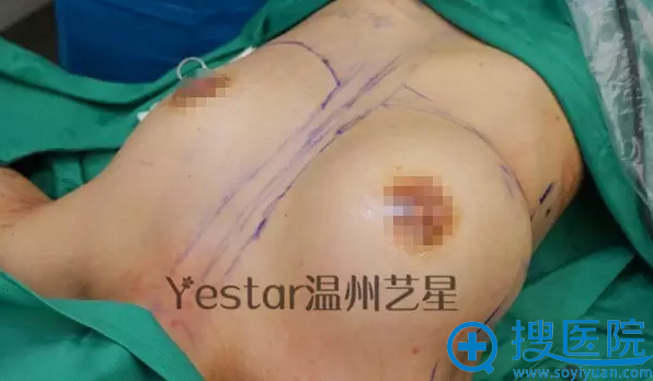 这是单侧乳房置入完硅胶假体的即刻效果 这是单侧乳房置入完硅胶假体的即刻效果