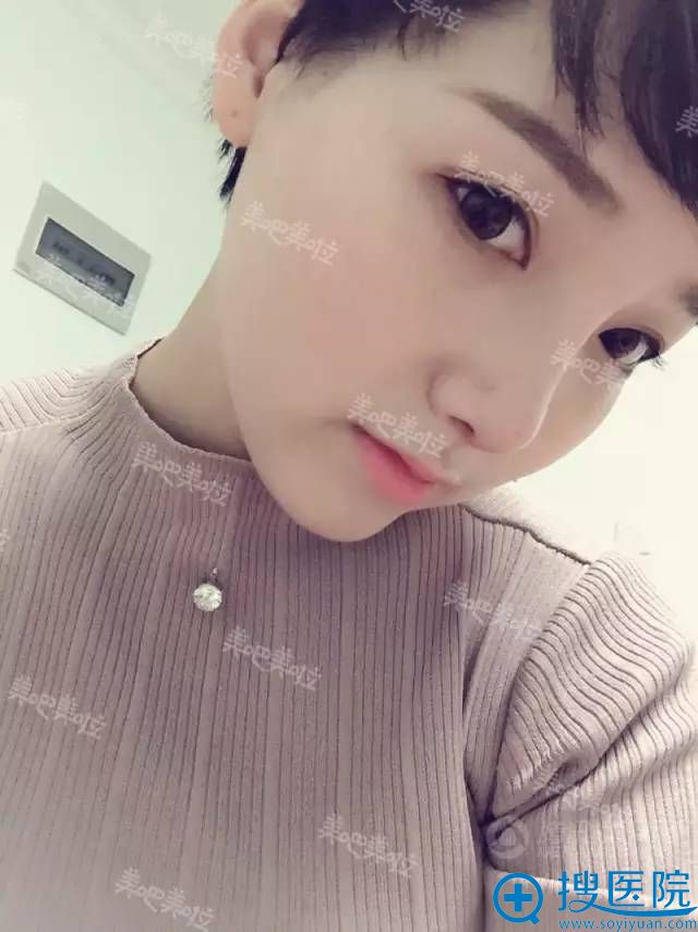 隆鼻后侧面照片 隆鼻后侧面照片