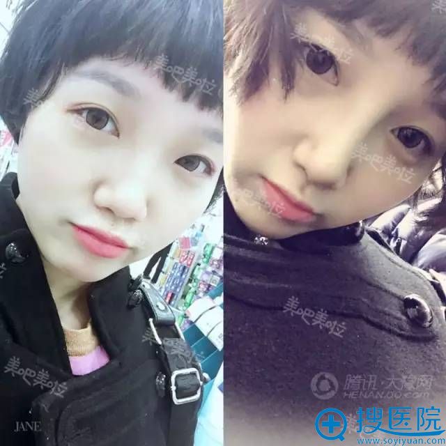 肋软骨隆鼻前后对比效果照片 肋软骨隆鼻前后对比效果照片