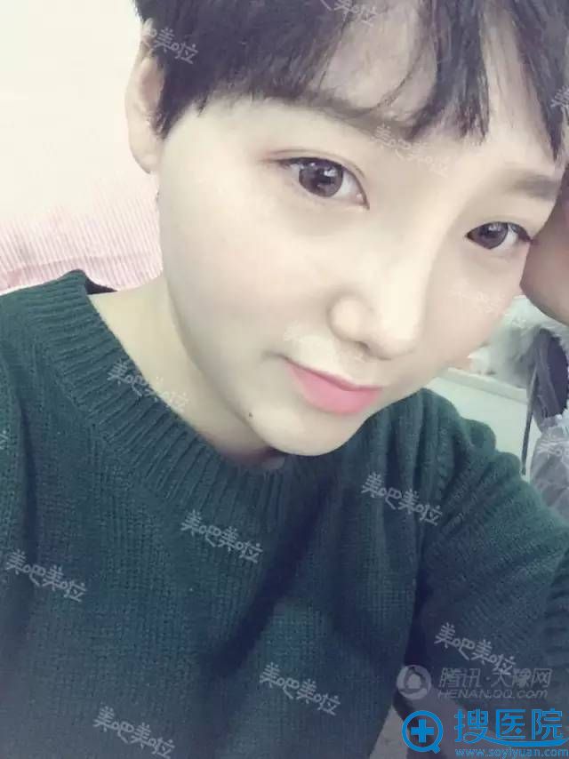 隆鼻手术15天后的效果 隆鼻手术15天后的效果