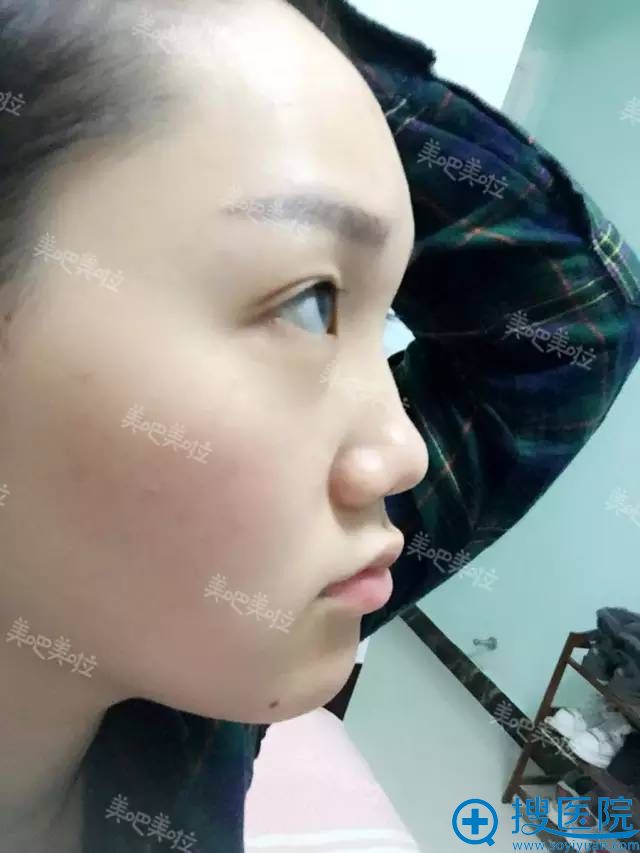 隆鼻手术前侧面照片 隆鼻手术前侧面照片