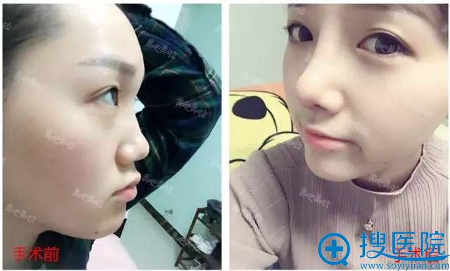 河南整形美容医院做自体肋软骨隆鼻前后对比照片 河南整形美容医院做自体肋软骨隆鼻前后对比照片