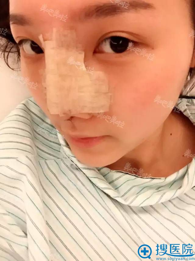 自体肋软骨隆鼻手术后当天的效果 自体肋软骨隆鼻手术后当天的效果