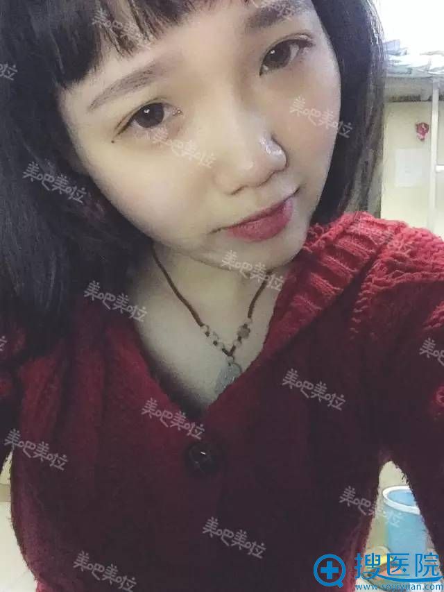 美容院注射玻尿酸隆鼻导致的阿凡达鼻 美容院注射玻尿酸隆鼻导致的阿凡达鼻