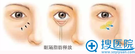 眶隔释放法祛眼袋手术过程 眶隔释放法祛眼袋手术过程