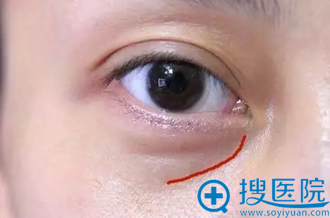 红线处就是泪沟 红线处就是泪沟